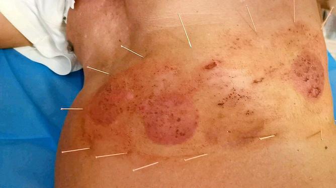 针灸治疗带状疱疹后遗症