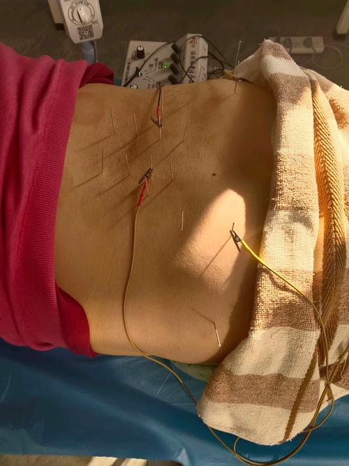 针灸腰椎间盘突出特效穴