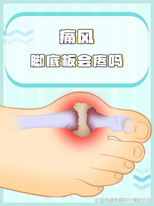 痛风突然脚疼的厉害怎么办