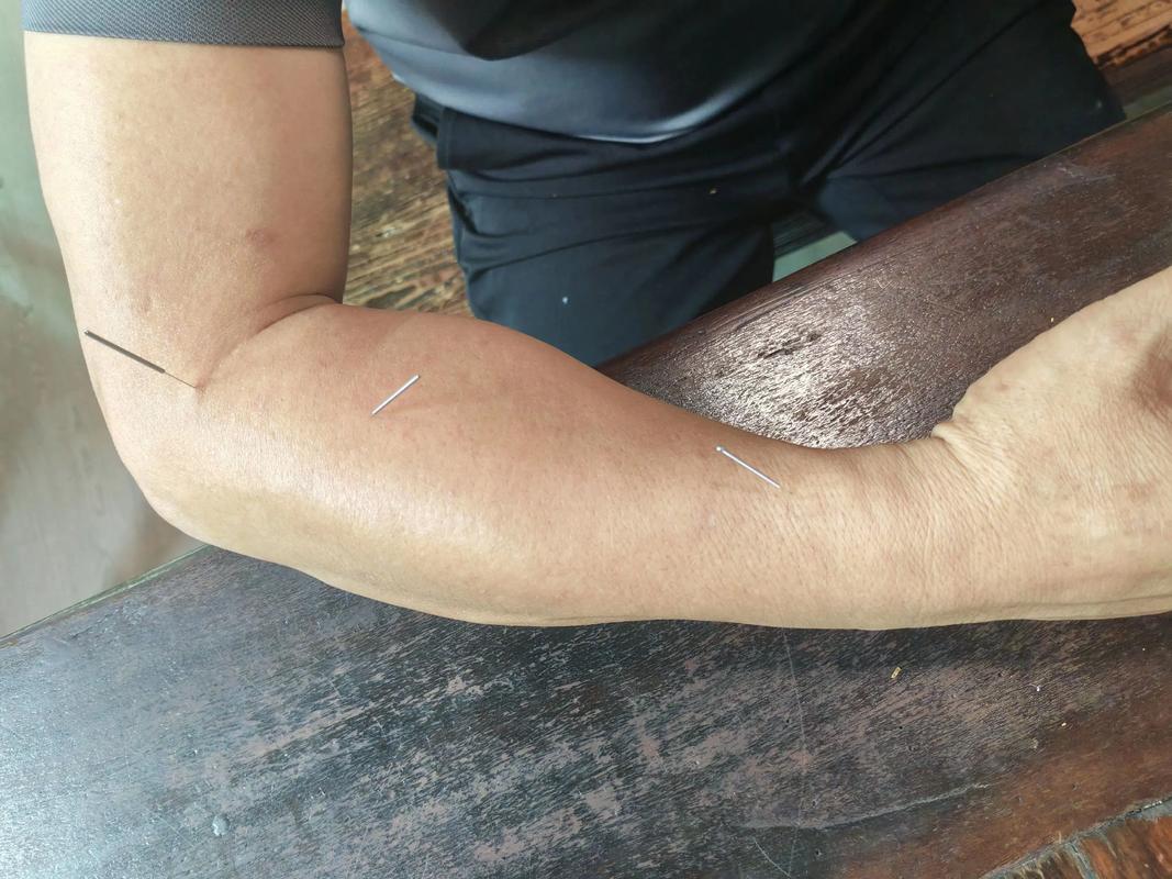 肘关节疼痛针灸哪些穴位