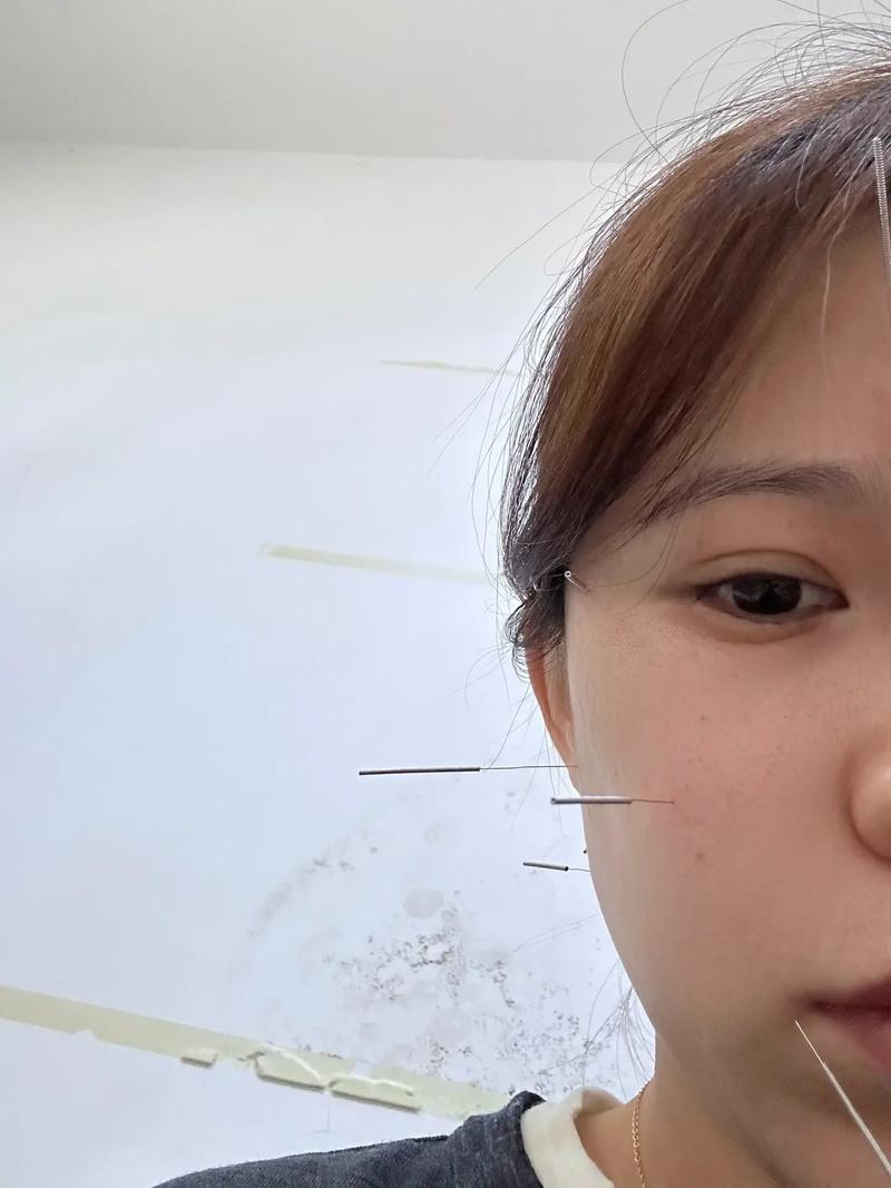 针灸治疗颞下颌关节紊乱