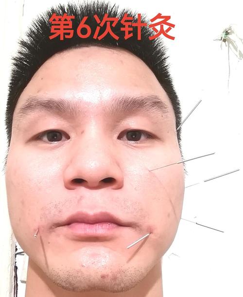 针灸治疗颞下颌关节紊乱