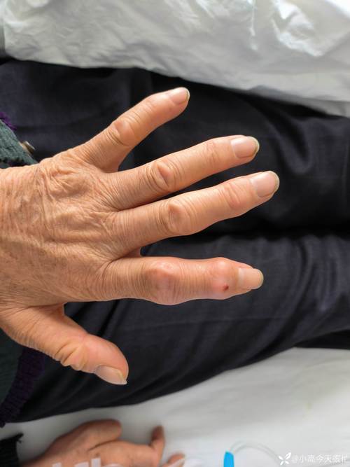 痛风一般手的哪个位置疼