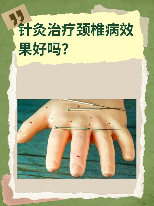 针灸治颈椎有什么副作用