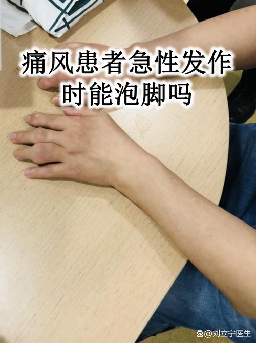 急性痛风关节炎多久能好