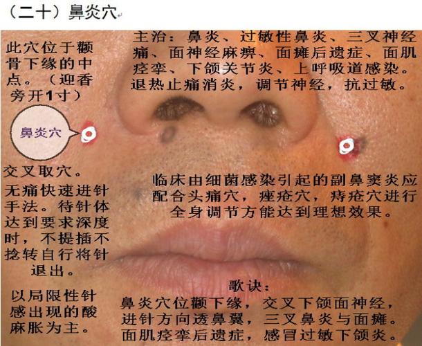 平衡针灸38个图解图册