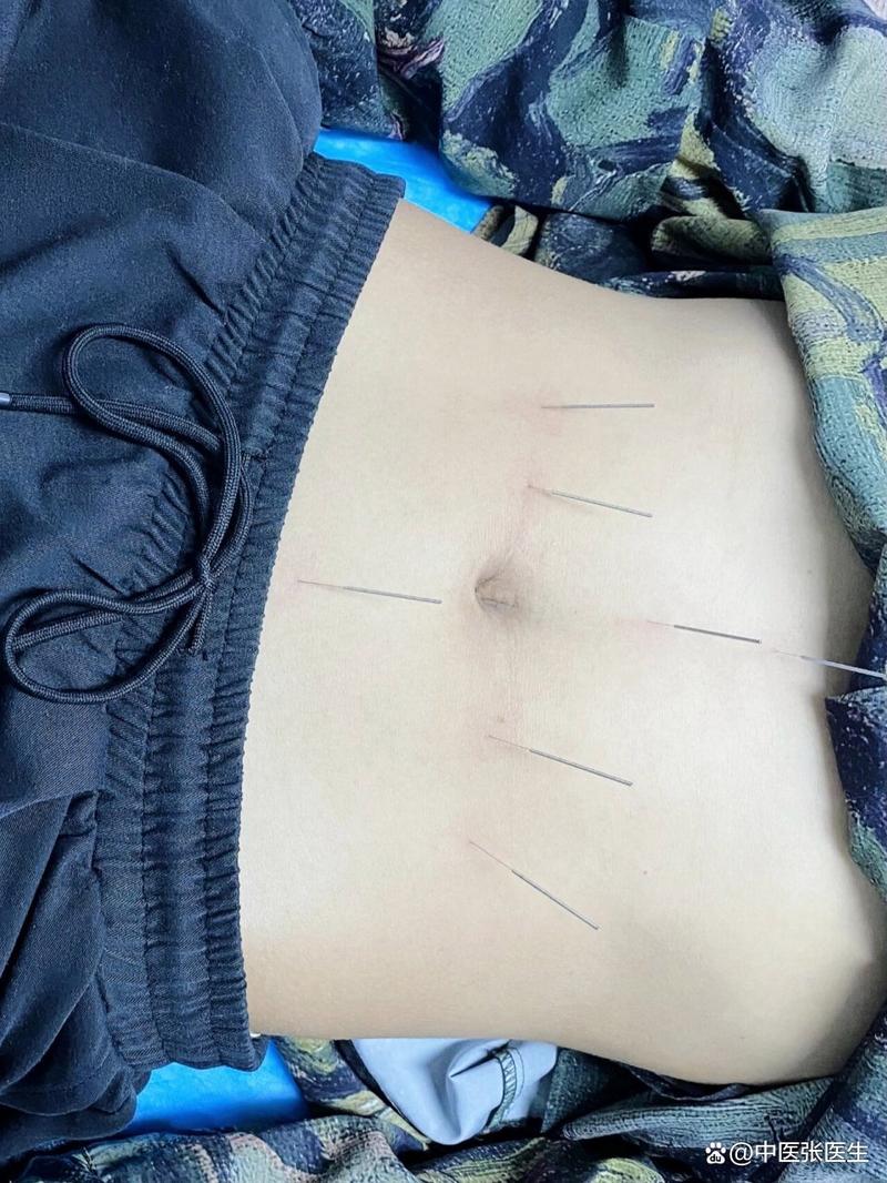 中医针灸治疗不孕不育