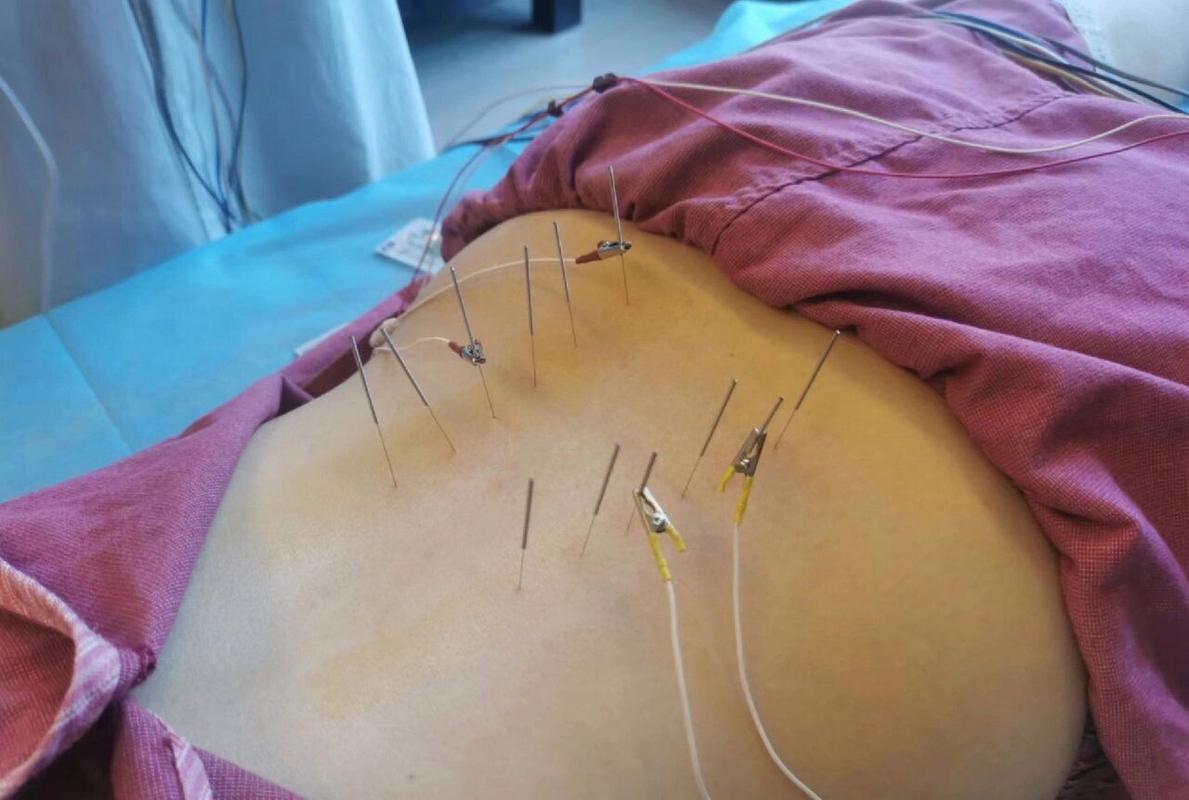 真人背部针灸图片大全