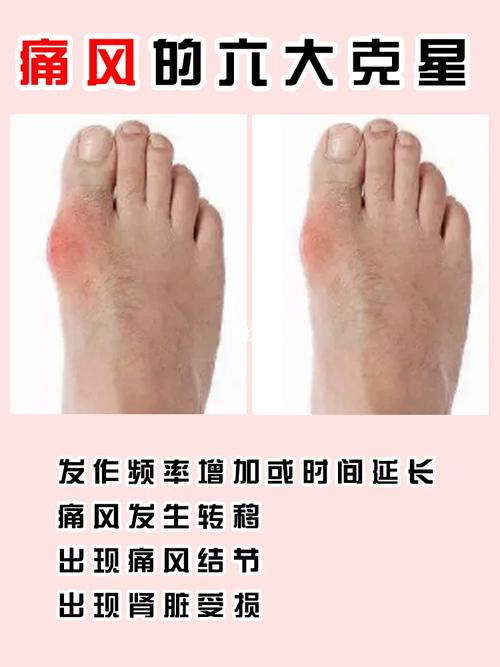 痛风可以跑1000米吗