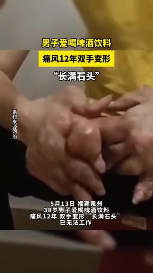 啤酒过量容易引起痛风病