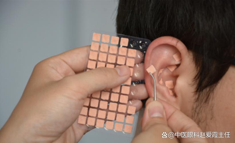 针灸耳朵放血治疗痘痘