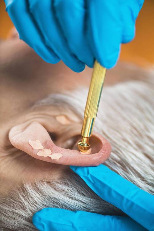 针灸耳朵放血治疗痘痘