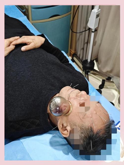 针灸治疗脑瘫八一优秀