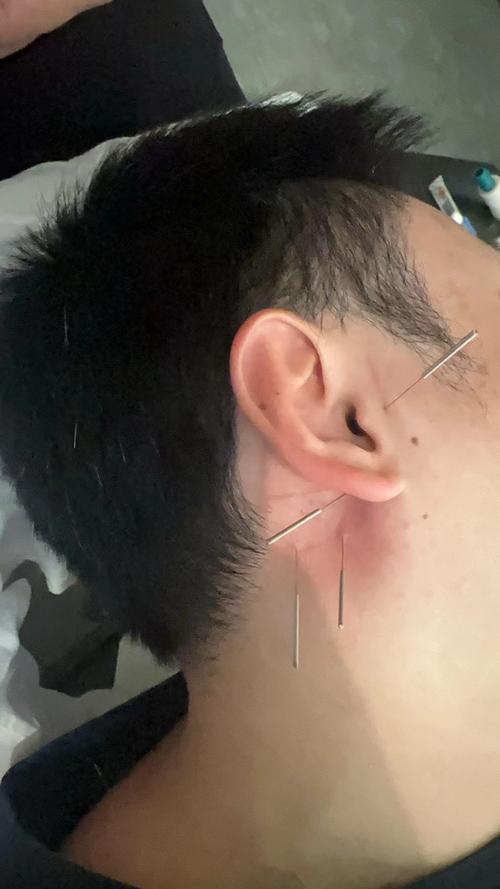 针灸治疗下颌神经损伤