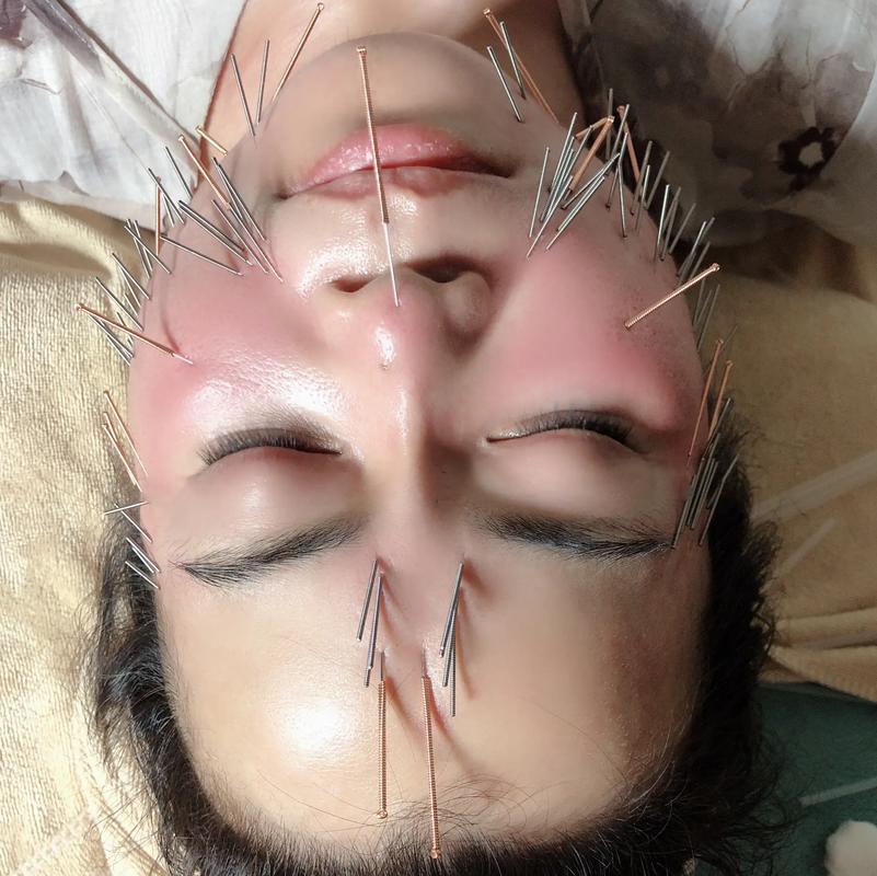 针灸治疗下颌神经损伤