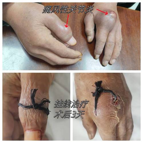 痛风急性关节炎期的治疗