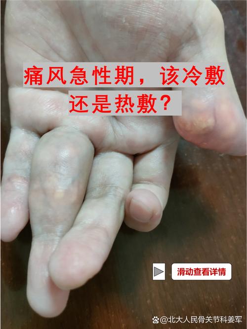 痛风发作时热敷还是冷敷