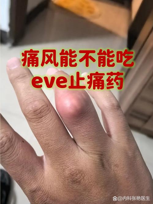 痛风发作时热敷还是冷敷