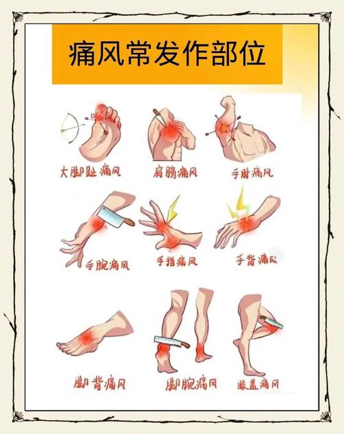 痛风病是什么原因引起的