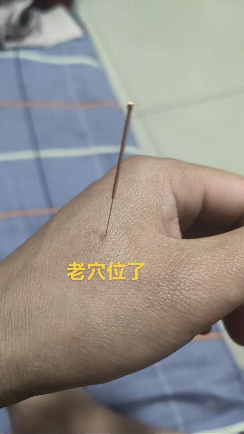 慢性咽炎针灸效果好吗