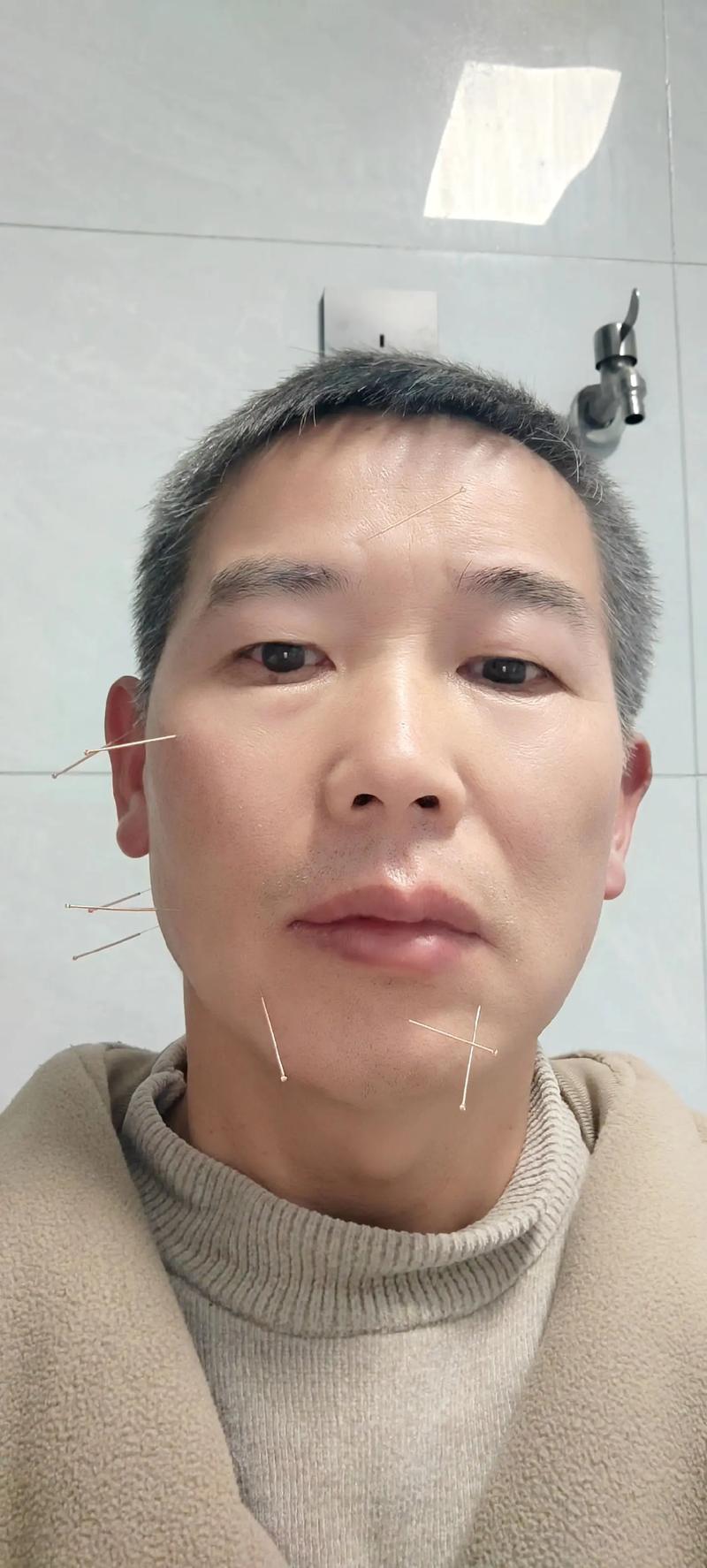 宝宝面瘫针灸多久会好