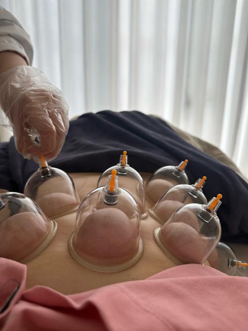 哪些医院可以针灸减肥