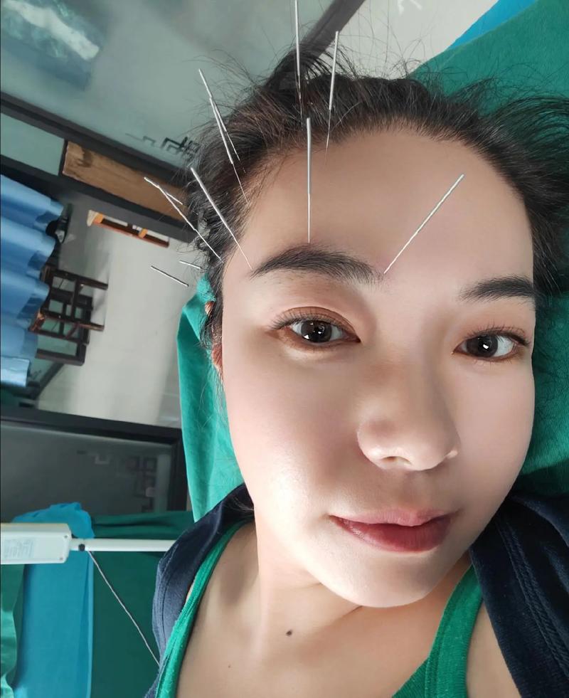 卵泡发育不好中医针灸