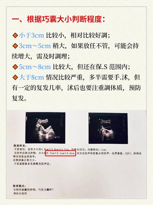 巧克力囊肿针灸有效吗