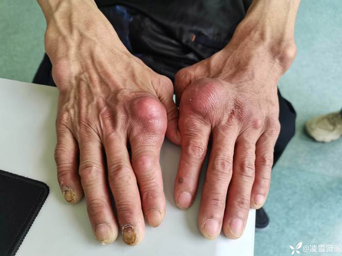 南京 鼓楼医院 痛风