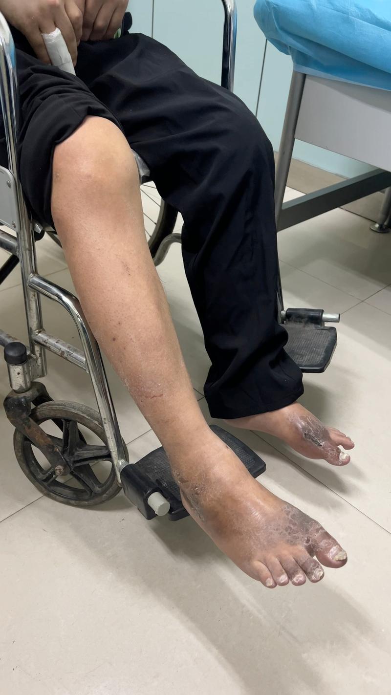 南京 鼓楼医院 痛风