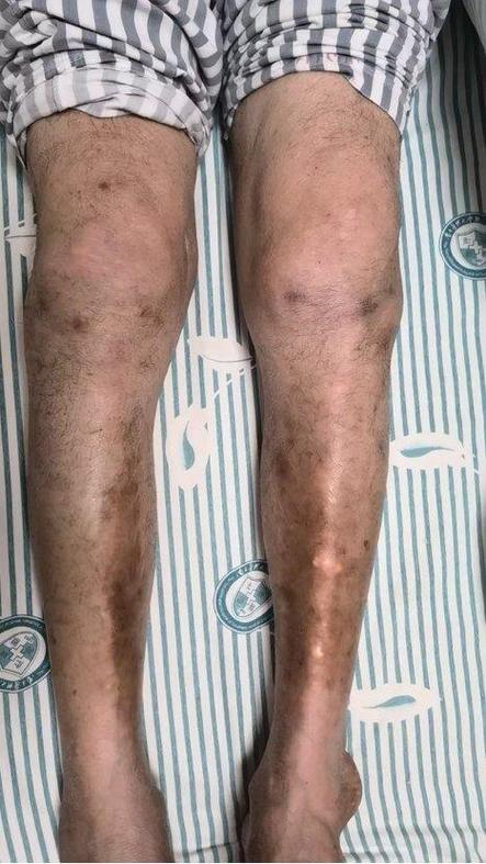 痛风膝盖长痛风石咋办