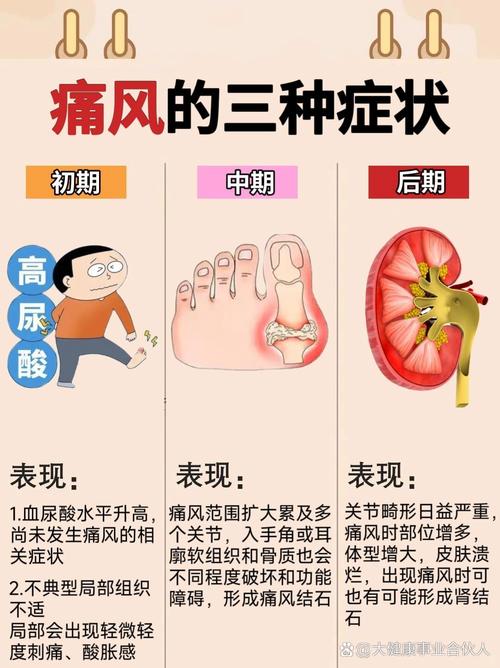 痛风不一定尿酸高对吗