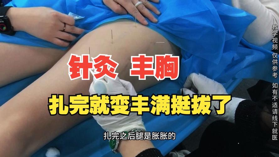 哪个医院能做针灸丰胸