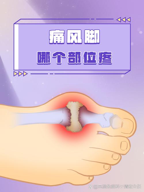 痛风一会左脚一会右脚