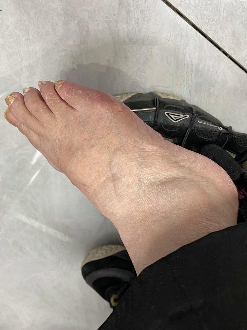 右侧肢体瘫痪如何针灸