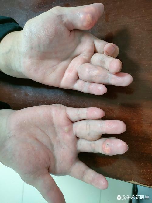 痛风可以用红外线照吗