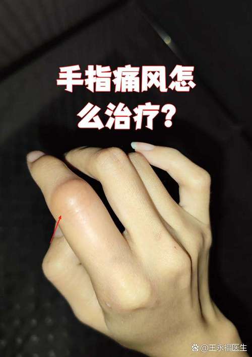 大拇指关节痛是痛风吗