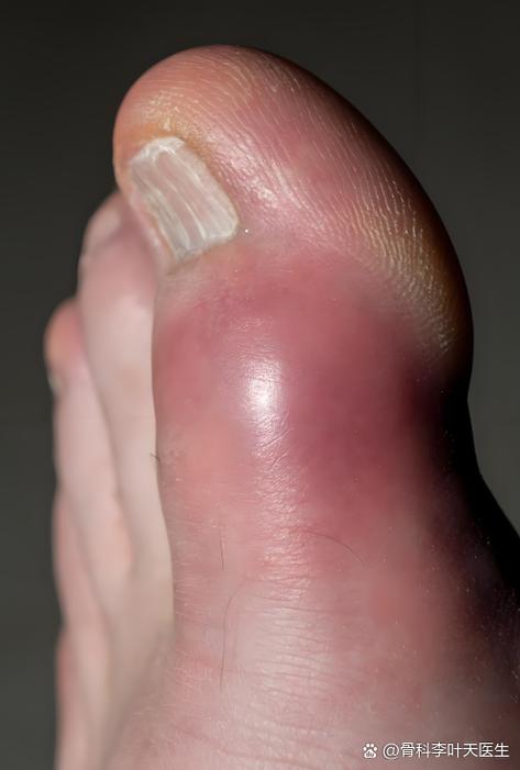 大拇指关节痛是痛风吗