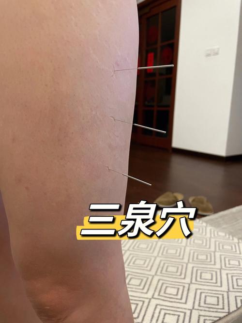 针灸能治三叉神经痛吗