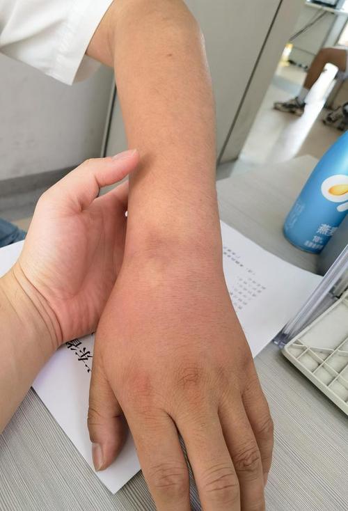 痛风能引起手腕子痛吗