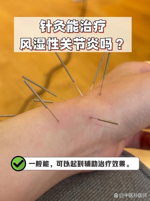 针灸治风湿性关节炎吗