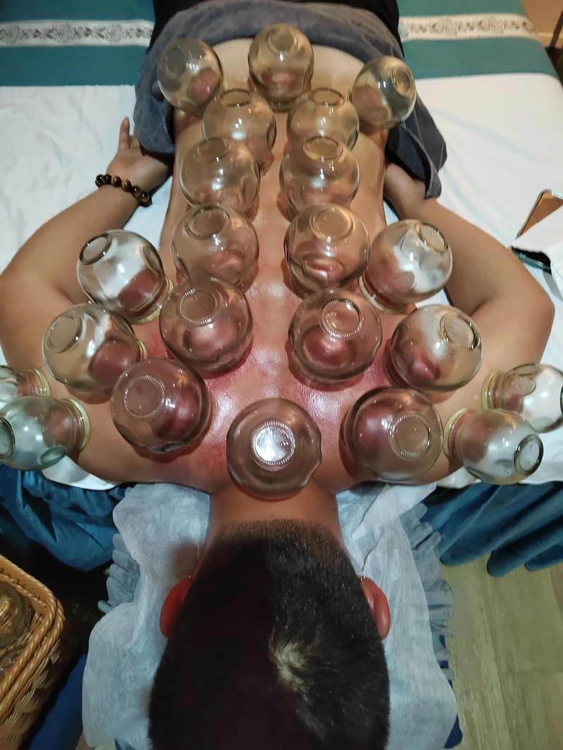 拔罐和针灸能一起做吗