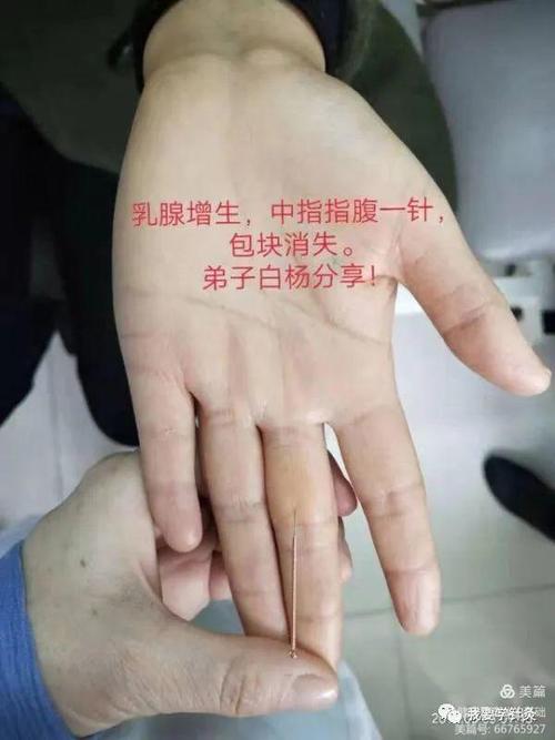 乳腺增生可不可以针灸