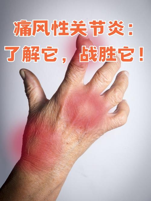 痛风性关节炎会遗传吗