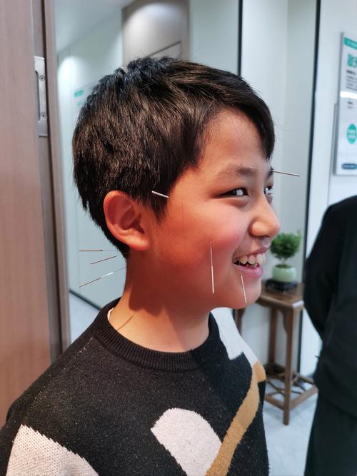 脑供血不足针灸可以吗