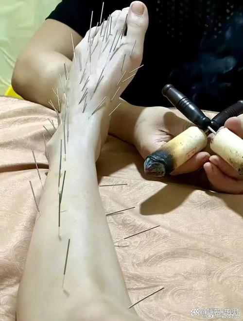 针灸拔罐治股骨头坏死