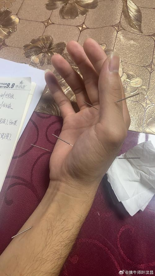 手指关节痛的针灸疗法