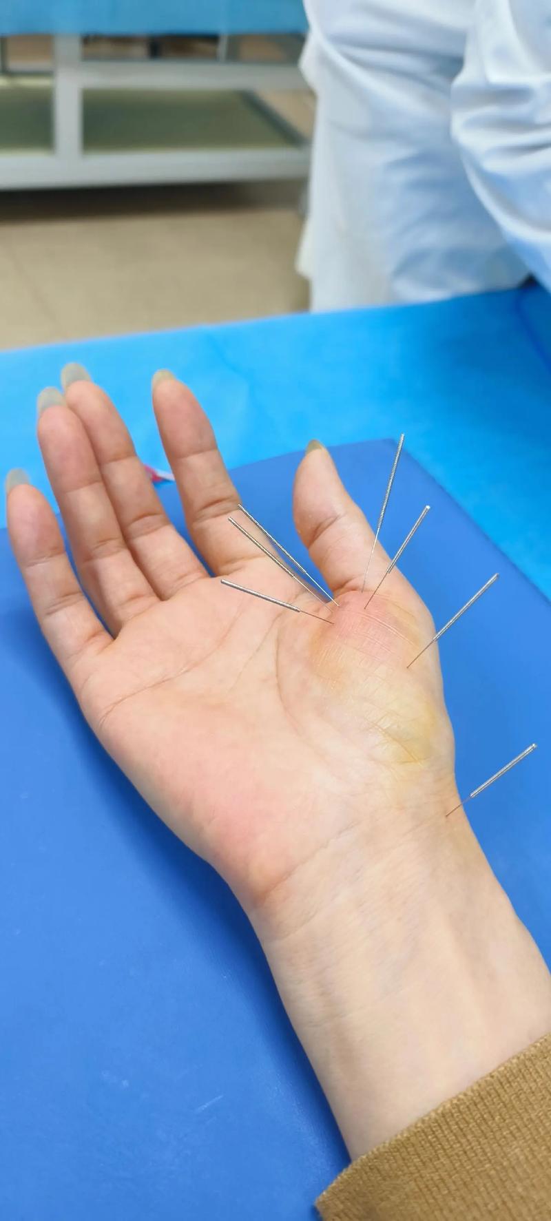 腕管综合症针灸有用吗