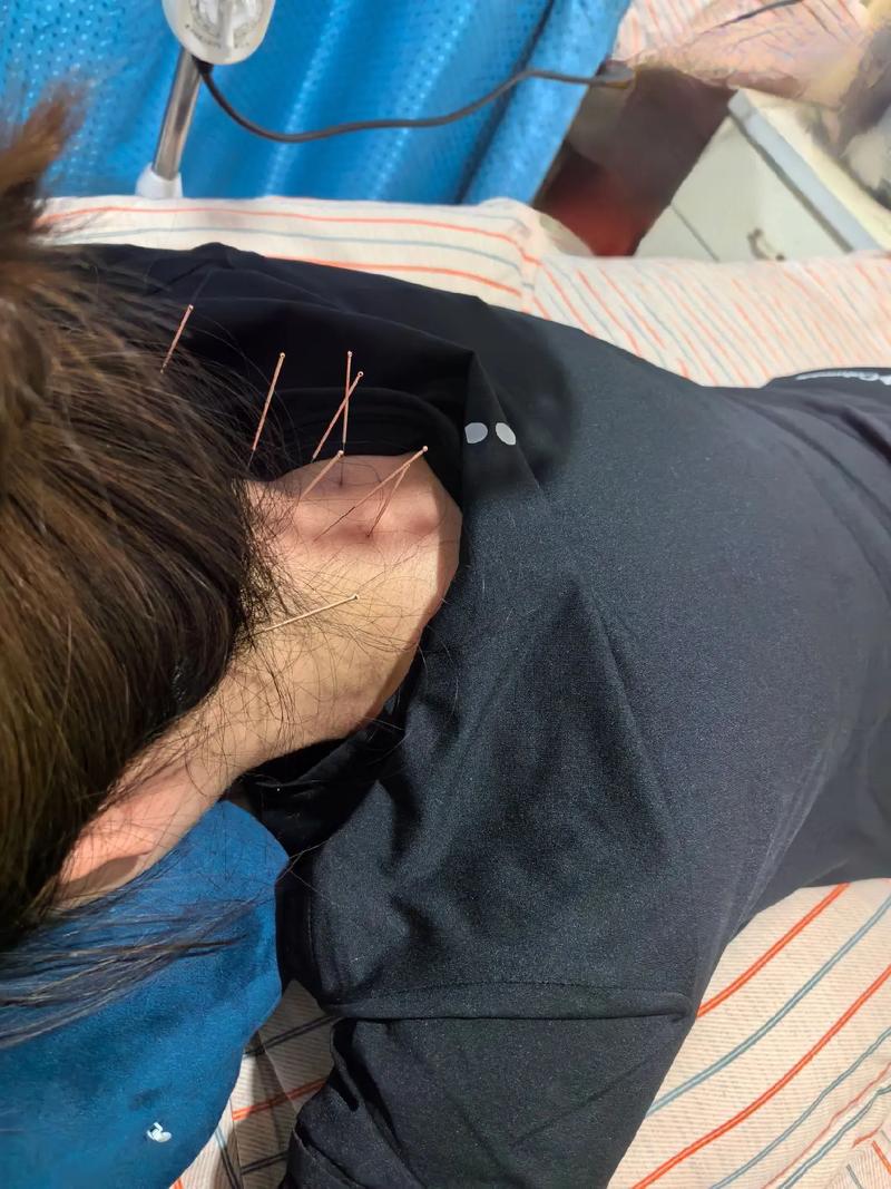 周围神经病能扎针灸吗