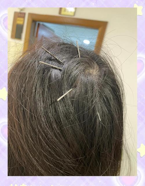 针灸对脑血管病的效果